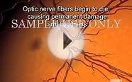 Diagnosis and Treatment of Closed Angle Glaucoma